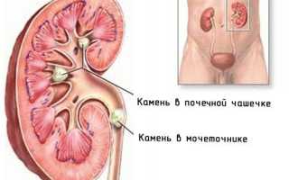Причина появления слизи в моче: что это значит?