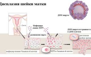 Дисплазия шейки матки 3 степени: терапия, отзывы врачей. Дисплазия шейки матки 3 степени: терапия в онкологии