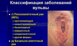 Белый налет в паху у женщин – всегда ли дело в грибке?