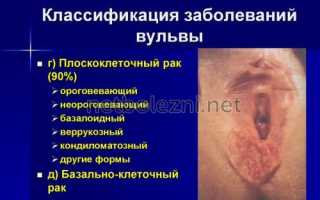 Белый налет в паху у женщин – всегда ли дело в грибке?